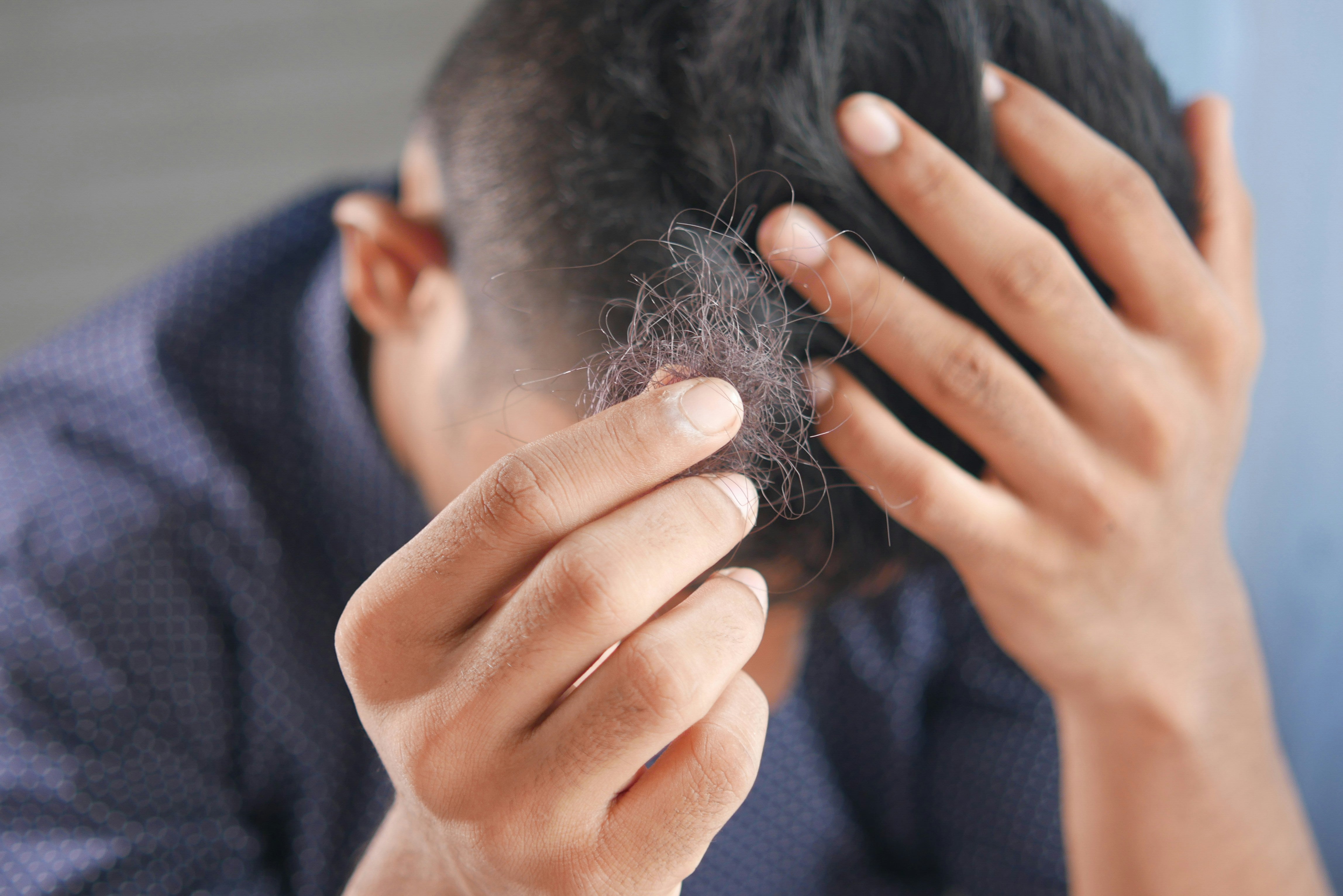 薄毛のサインを見逃さない：原因と今すぐ始める育毛習慣